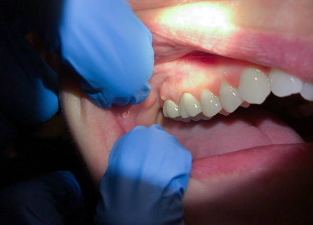 Best Emergency Dental Care for Broken or Chipped Teeth in Worland, WY